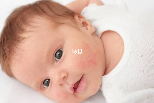 婴儿湿疹最怕的克星是保湿