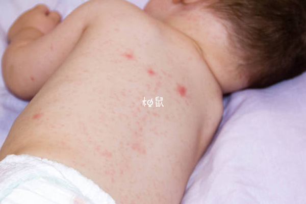 婴儿湿疹最怕的克星是保湿