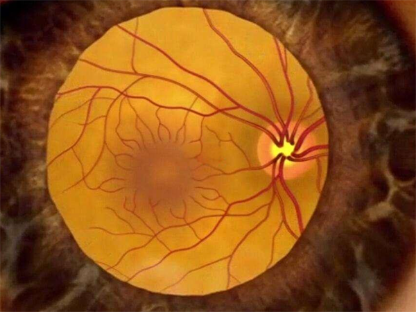 三代试管可以避免青光眼遗传