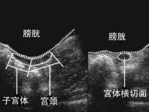 幼稚子宫大多无法生育