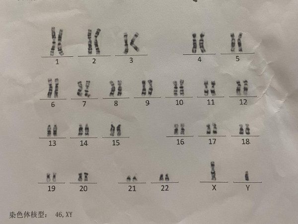 45染色体异常是特纳综合征