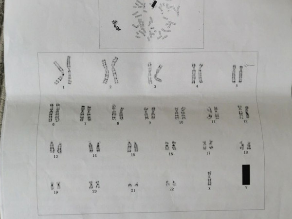 染色体片段缺失后果严重