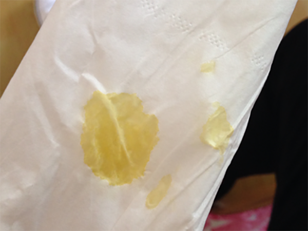 移植后第七天纸巾上有一坨黄色的东西正常吗？