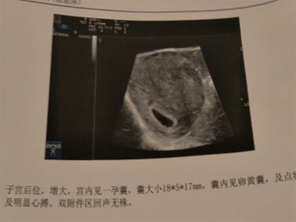 囊胚移植后31天孕囊多大正常吗?