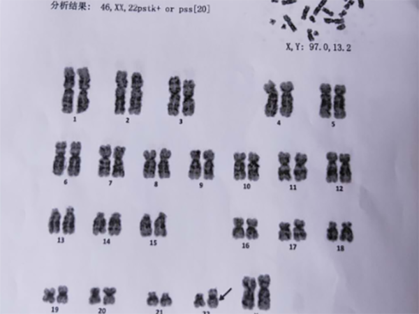 胚胎22号染色体三体一定做三代吗？