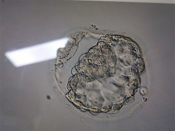 有没有0PN囊胚移植成功的案例？