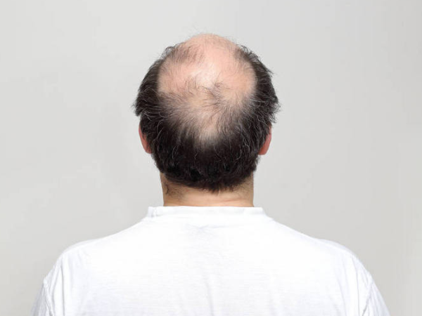 秃头基因的遗传方式是什么