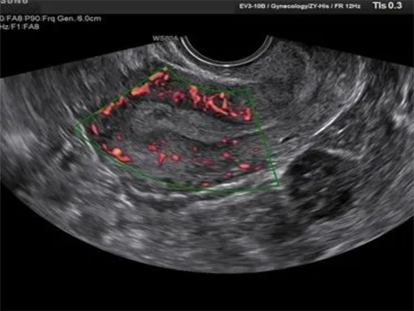 试管为什么要检查子宫动脉血流？
