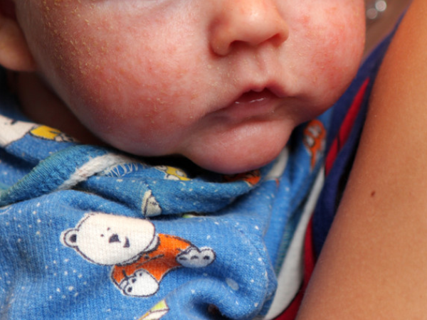 新生儿脸上长红疹是什么情况