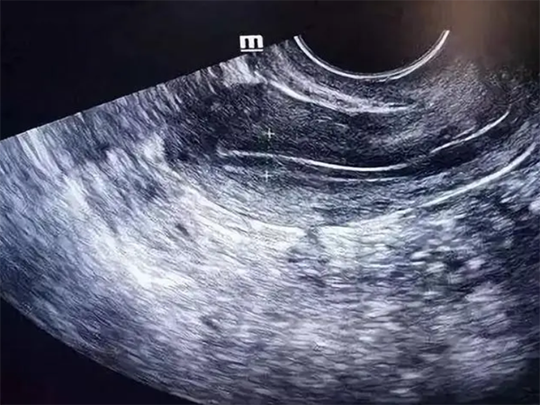 鲜胚移植子宫内膜是越厚越好吗？