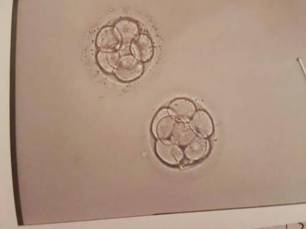 5BB囊胚和4BB囊胚可以同时移植吗？