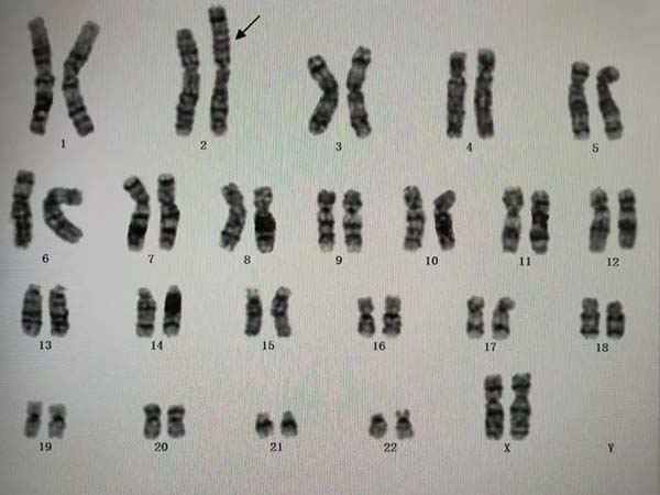 胚胎14三体夫妻双方需查染色体全套吗？
