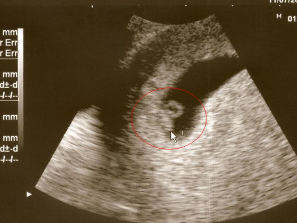孕期出现空孕囊的原因