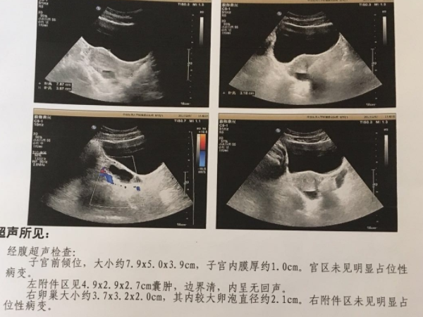 卵巢囊肿对试管有没有影响