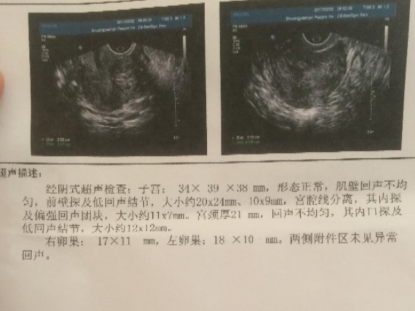 内膜息肉会不会影响试管移植