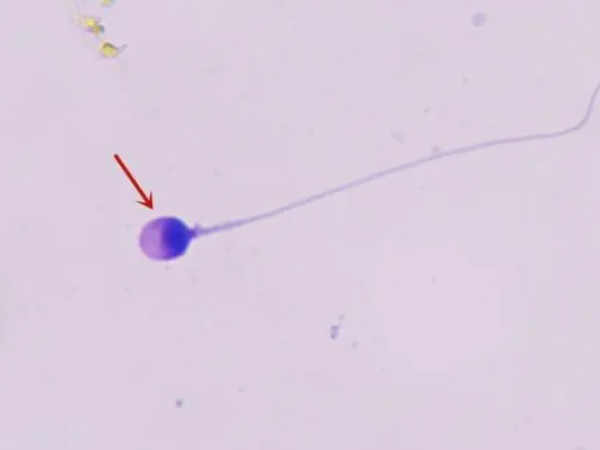 圆头精子症做试管能不能成功