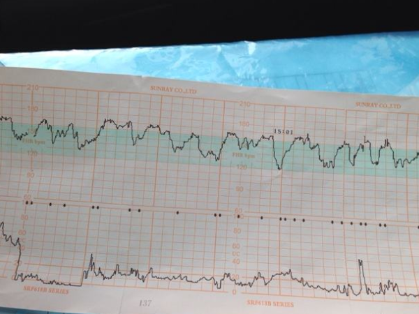 胎心率163正不正常