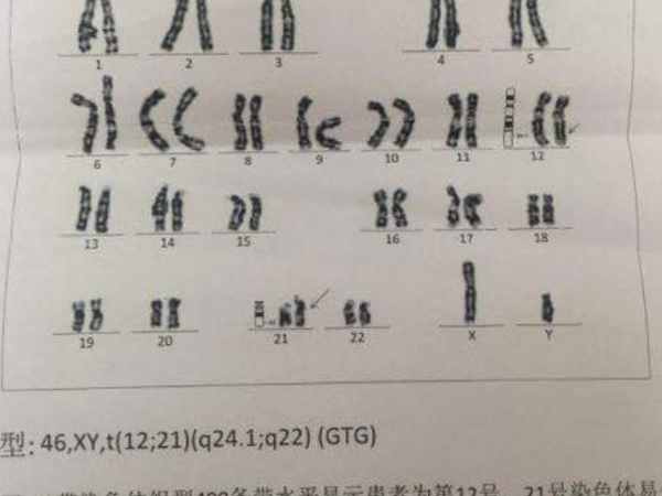 15号染色体缺失的孩子会怎样