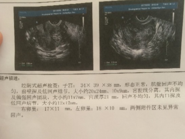 子宫内膜息肉是什么