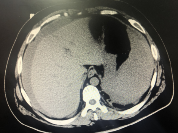 腹腔24mm积液能不能移植