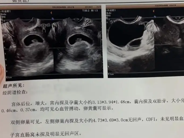 自然周期怀双胞胎几率公开,附提升双胎概率方法分享 - 柚鼠知识