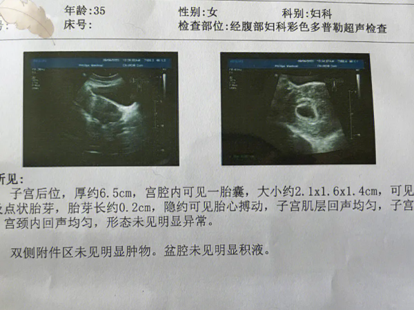 弓形子宫凹陷能不能怀孕