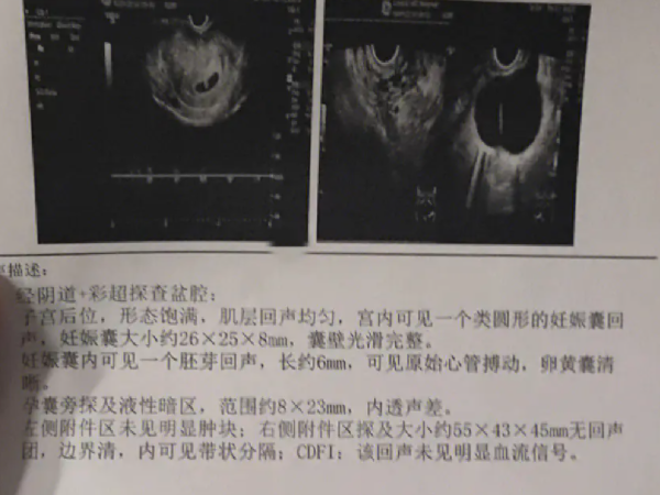 宫腔积液试管移植能不能成功