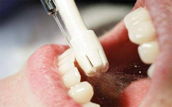 国外禁止洗牙与习惯有关