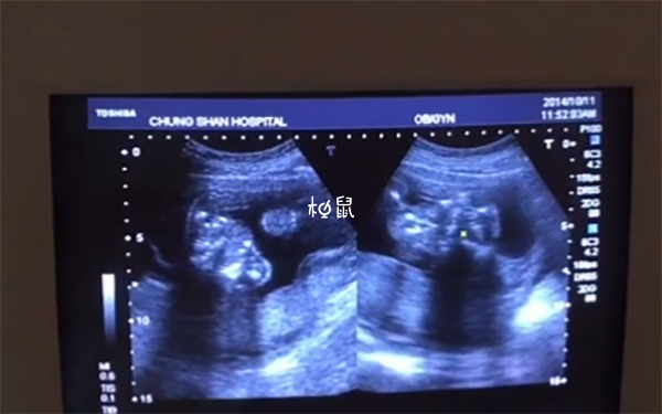 移植4bb囊胚后裂变成同卵双胞胎是好事还是坏事？