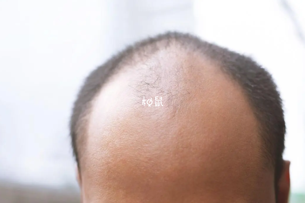 秃头基因的遗传方式有多基因遗传