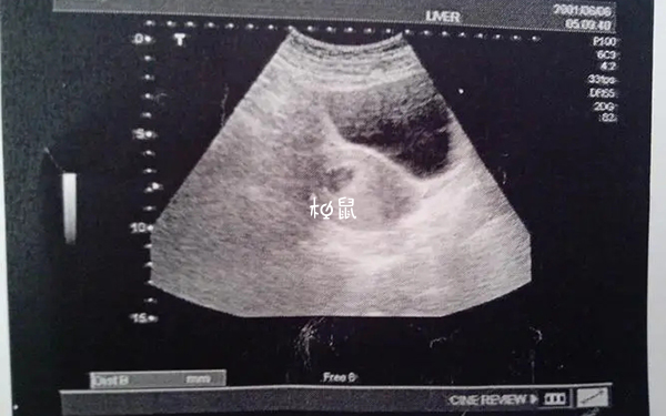 移植31天孕囊大小在2-2.5cm正常