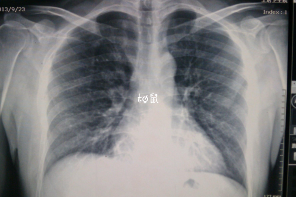 试管拍胸片可以检查肺部健康