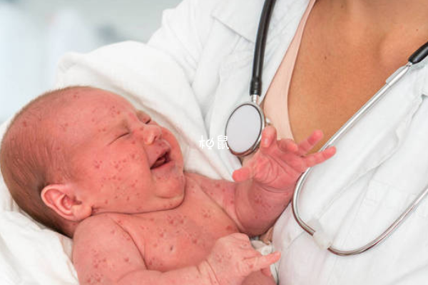 新生儿脸上长红疹可能是手足口病