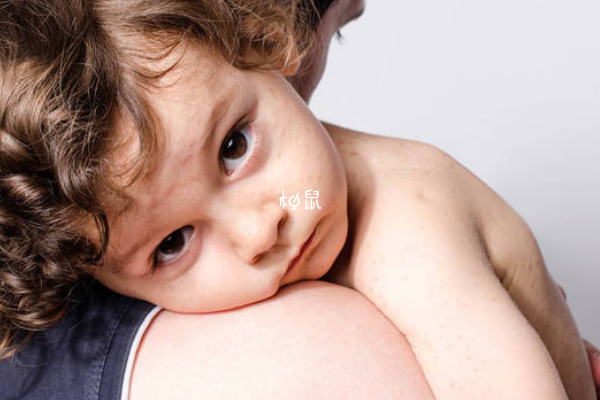 宝宝红疹可能是遗传导致的