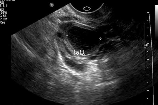卵巢黄体破裂出血会导致宫外孕