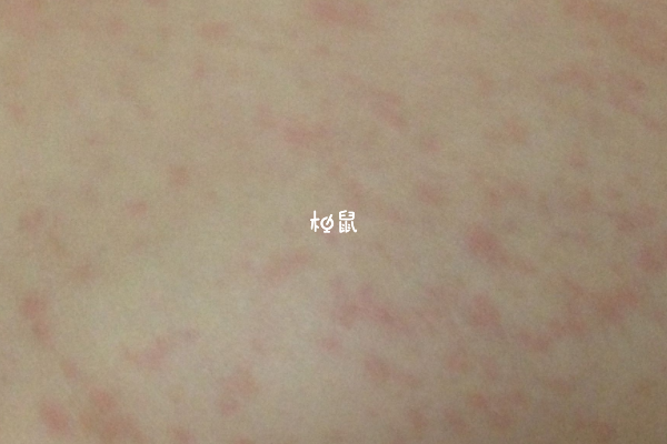 腮腺炎容易导致不孕不育