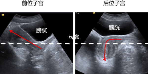 子宫后位不会影响怀孕