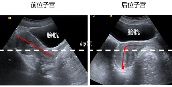 子宫后位受孕率不固定