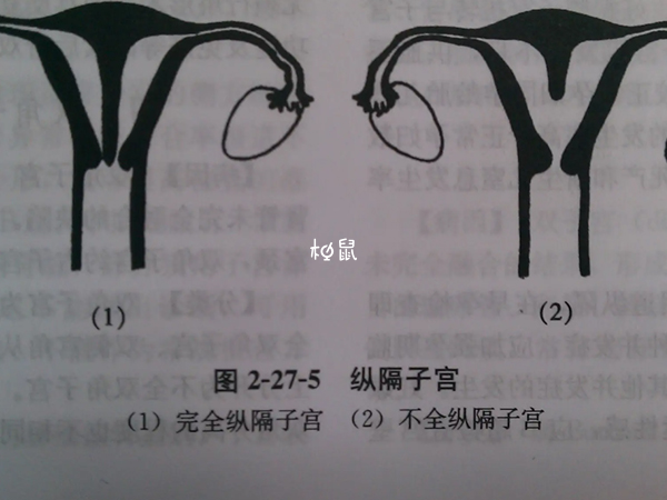 纵隔子宫做试管能否成功要看情况