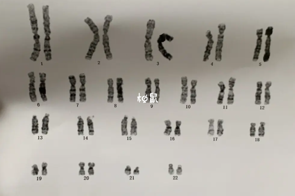 15号染色体有问题很难治疗