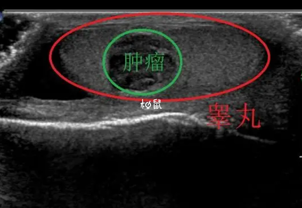 阴囊炎性癌做试管有机会成功