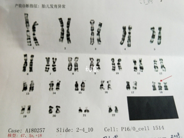 染色体异常也能做试管