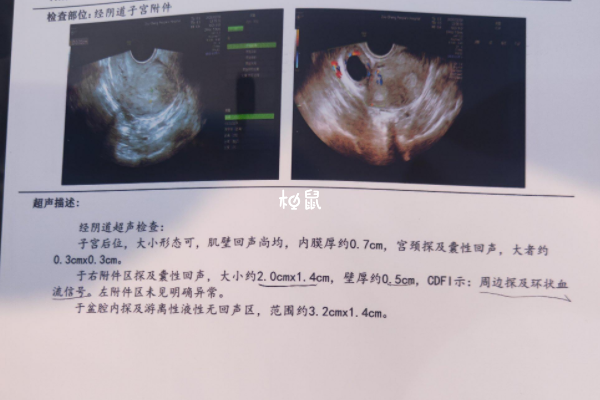 移植宫外孕几率约为2%-5%