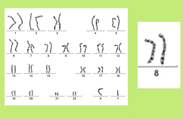 y染色体携带的基因遗传病有不育症