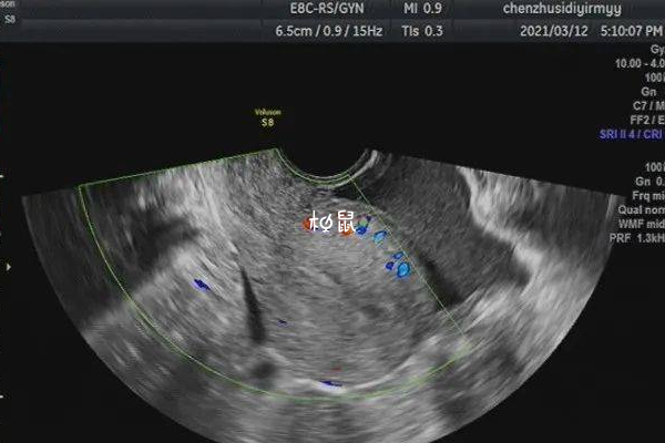 子宫b超图片的红蓝点是血液循环