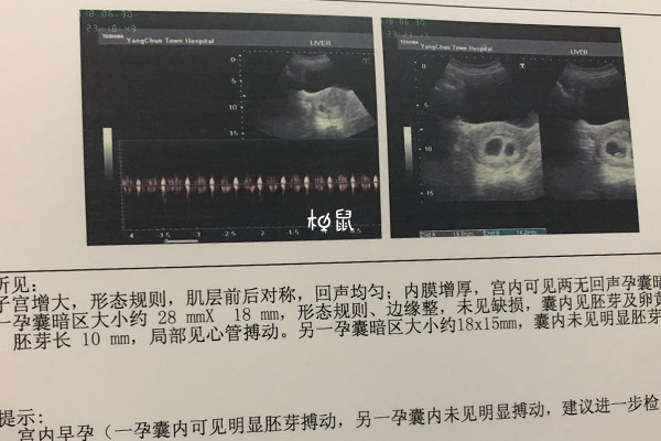 58岁试管怀龙凤胎的成功率约20%