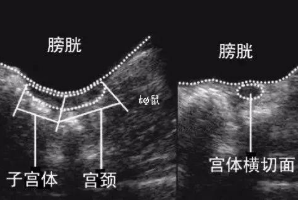 幼稚子宫试管婴儿成功率不固定