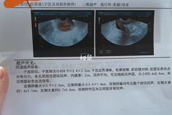 没有优势卵泡要定期进行检查