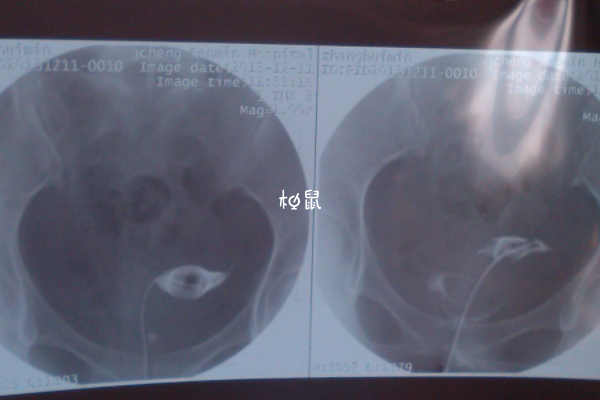 单角子宫不建议做试管怀双胞胎