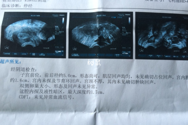 内膜不典型增生试管前准备工作一览